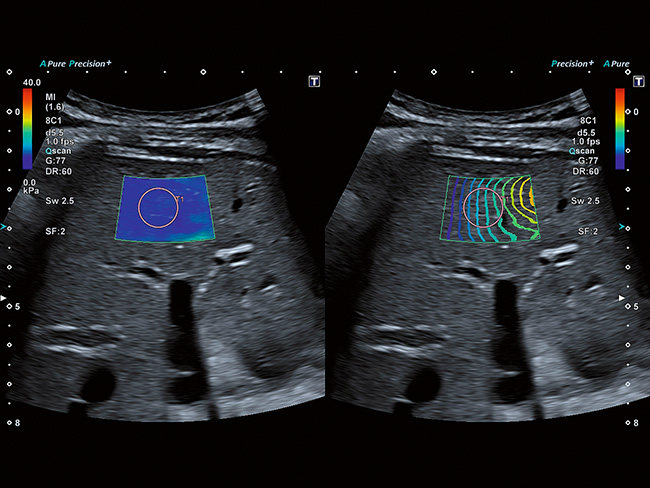 Еластографія зсувної хвилі